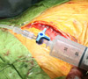 Casos clínicos. Ductus Arterioso